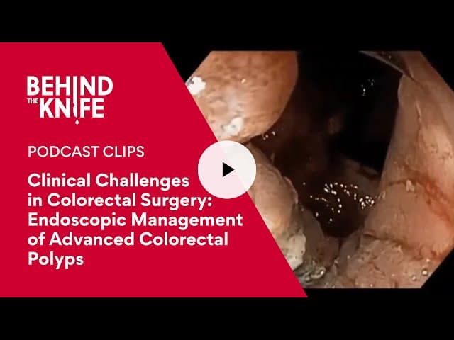 Clinical Challenges in Colorectal Surgery: Endoscopic Management of Advanced Colorectal Polyps