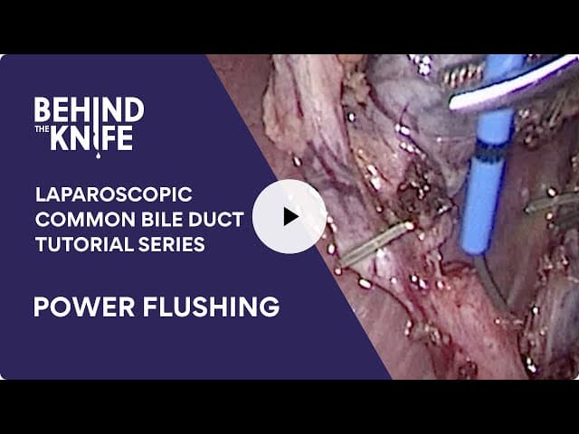 Power Flushing | Laparoscopic Common Bile Duct Tutorial Series: Ep. 3