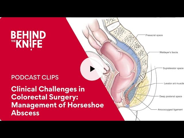 Clinical Challenges in Colorectal Surgery: Management of Horseshoe Abscess
